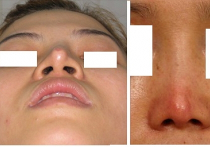 Nâng mũi bị lệch – 3 tác nhân tối kỵ khi nâng mũi khiến mũi bị lệch sóng